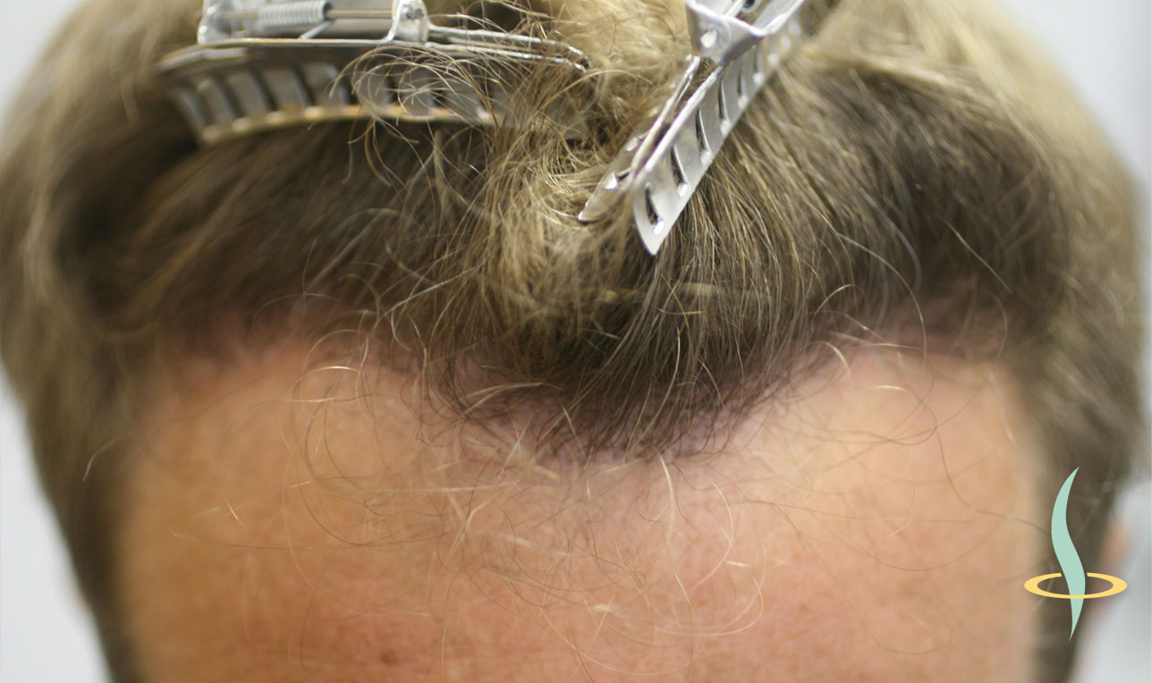 Haaransatz nach der Eigenhaartransplantation.